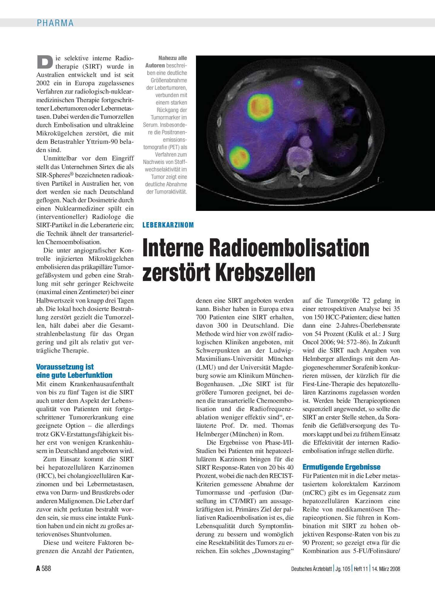 Vorschauseite 1: Leberkarzinom: Interne Radioembolisation zerstört Krebszellen – Deutsches Ärzteblatt