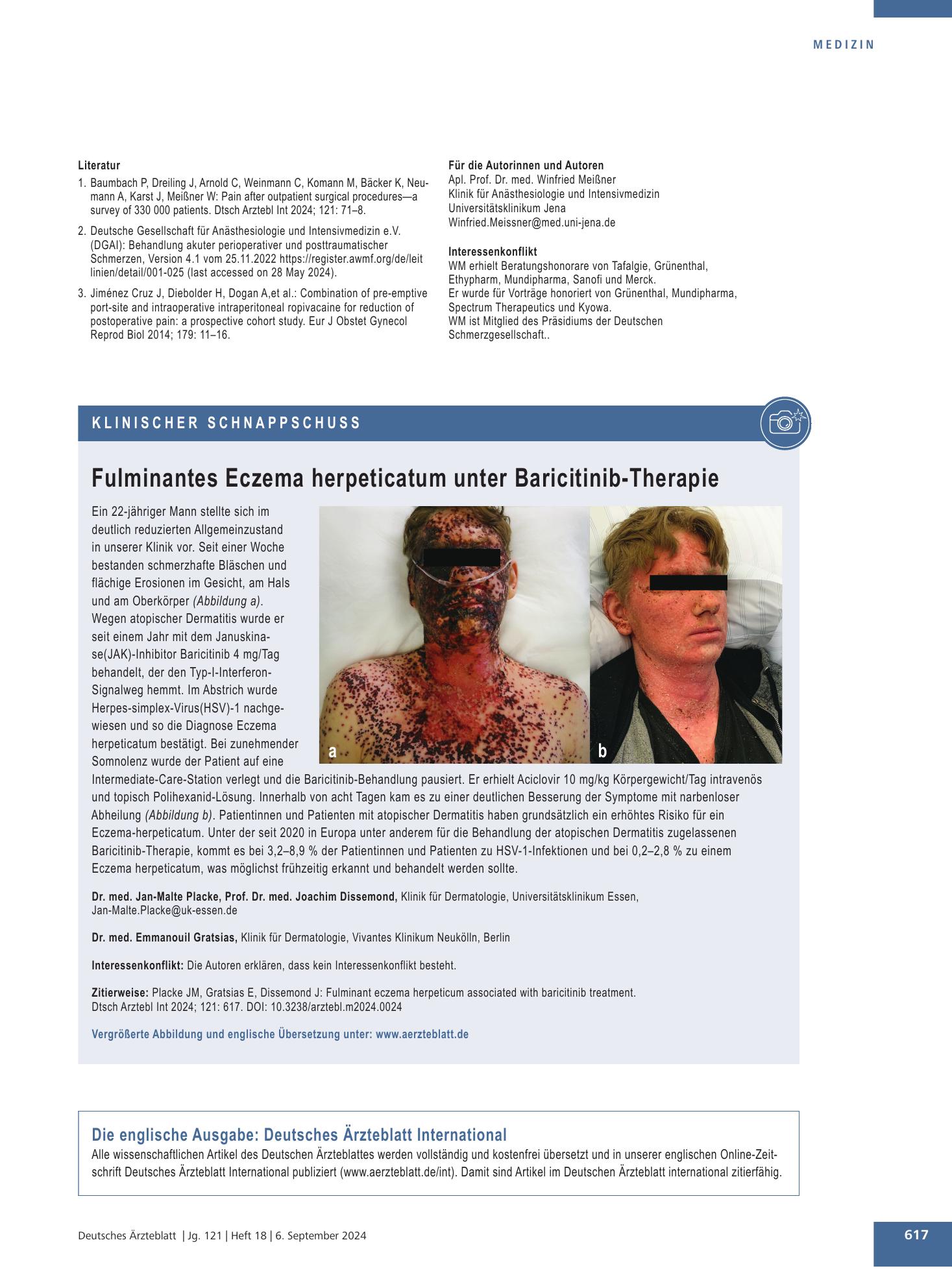 Vorschauseite 1: Fulminantes Eczema herpeticatum unter Baricitinib-Therapie – Deutsches Ärzteblatt