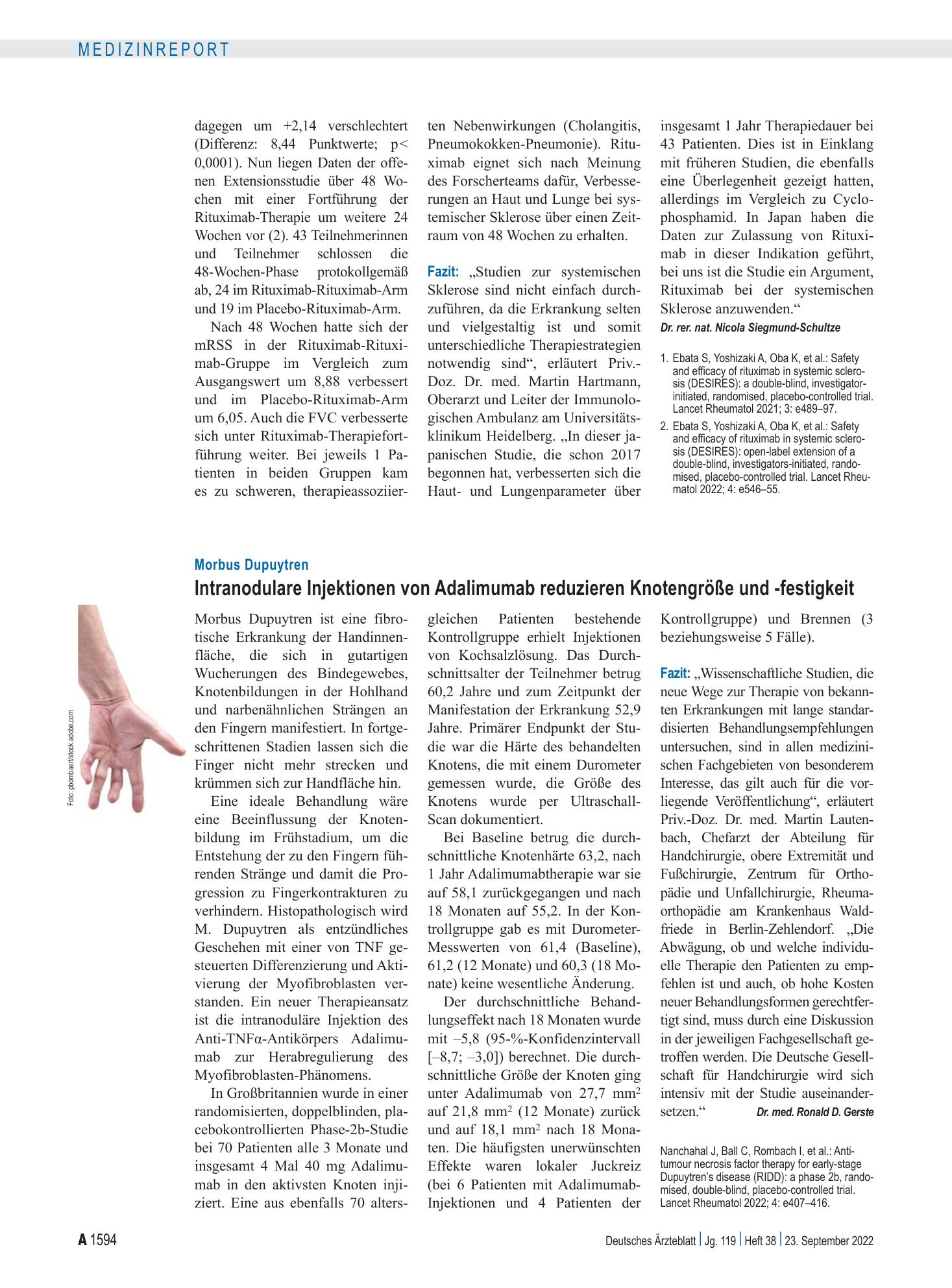 Vorschauseite 1: Morbus Dupuytren: Intranodulare Injektionen von Adalimumab reduzieren Knotengröße und -festigkeit – Deutsches Ärzteblatt