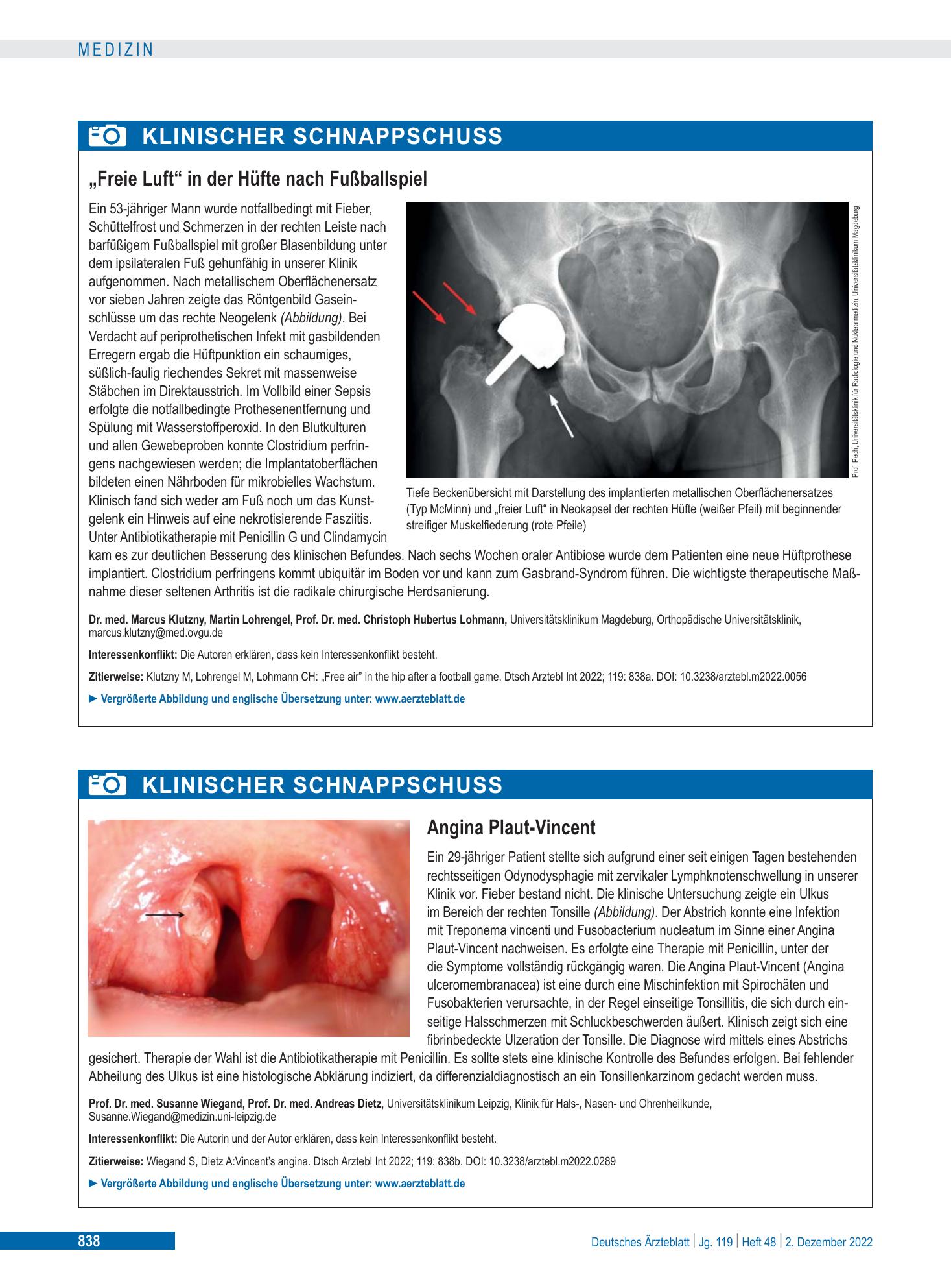 Vorschauseite 1: Angina Plaut-Vincent – Deutsches Ärzteblatt