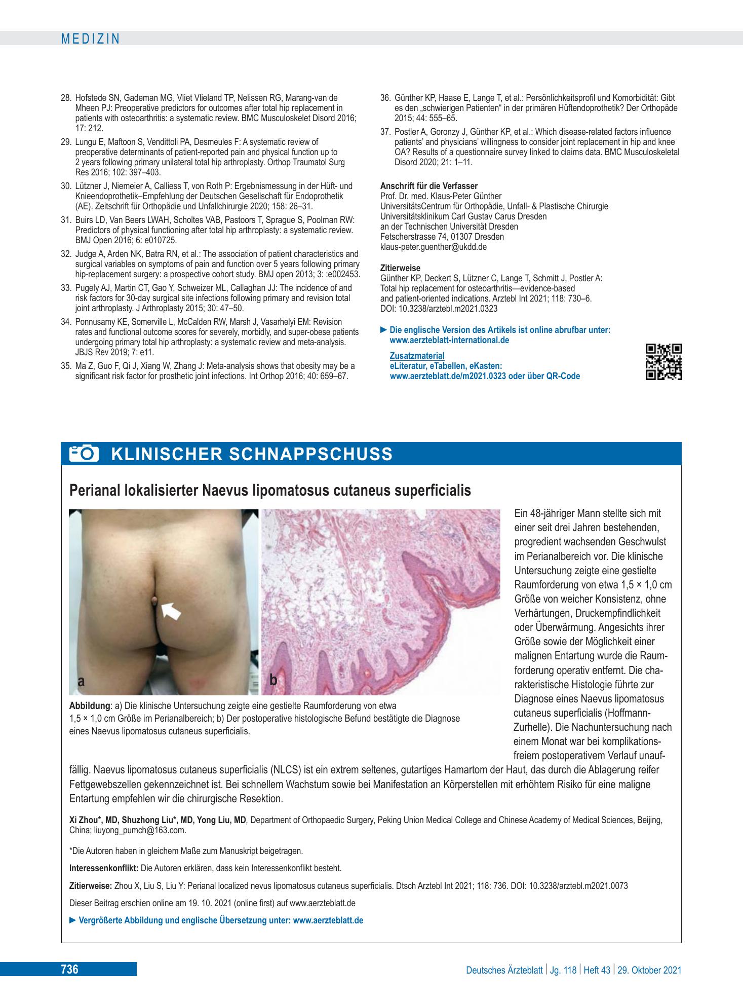 Vorschauseite 1: Perianal lokalisierter Naevus lipomatosus cutaneus superficialis – Deutsches Ärzteblatt