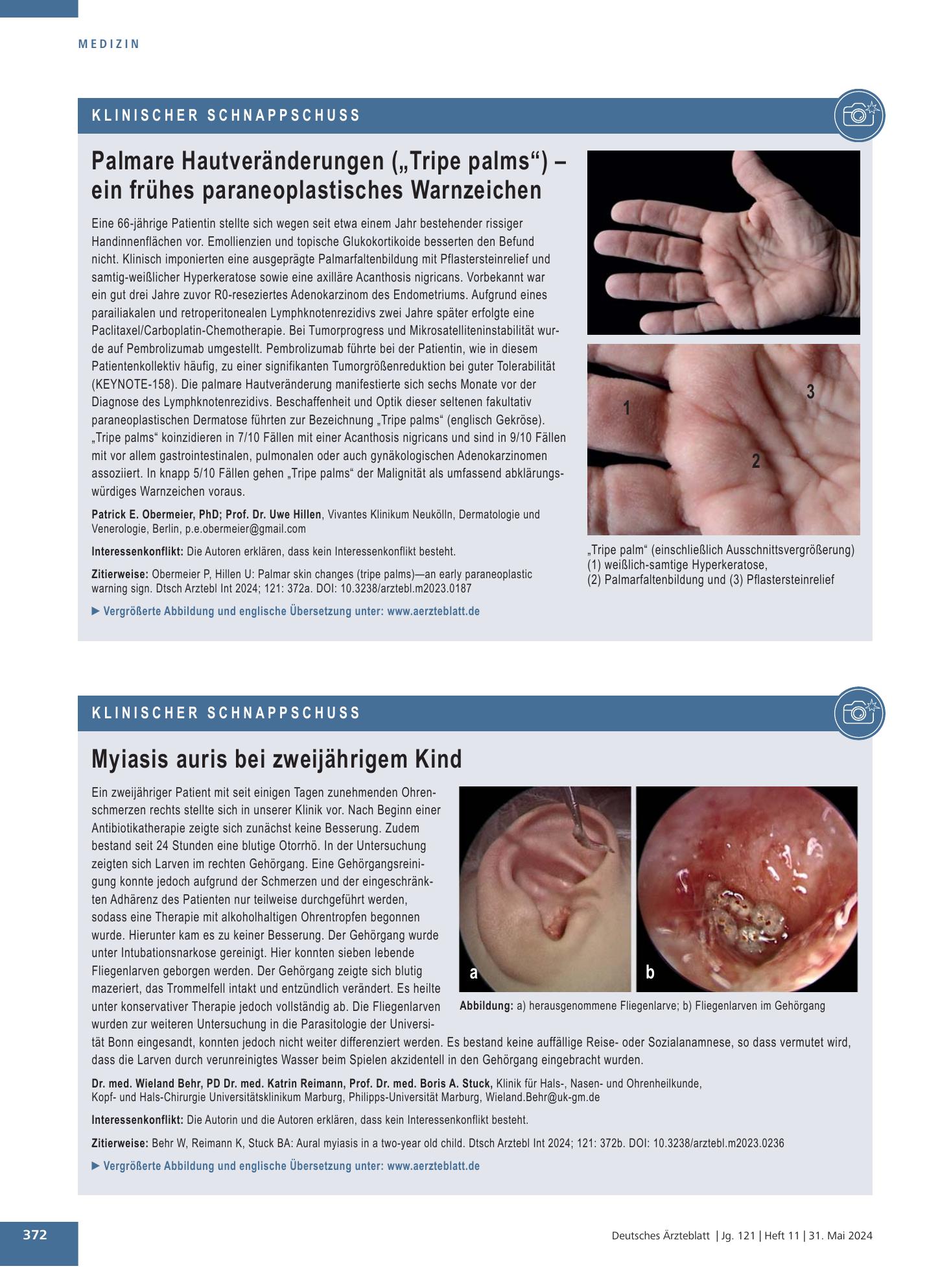 Vorschauseite 1: Palmare Hautveränderungen („Tripe palms“) – ein frühes paraneoplastisches Warnzeichen – Deutsches Ärzteblatt
