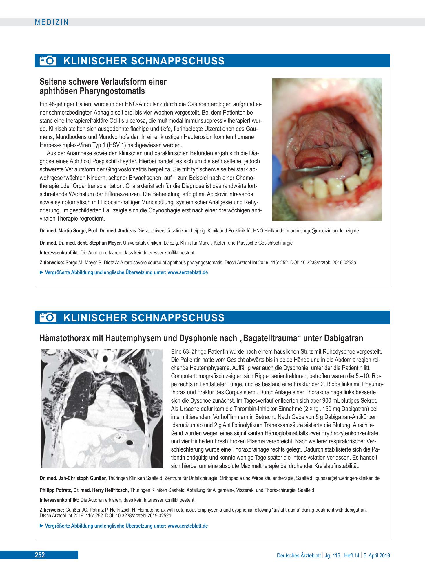Vorschauseite 1: Hämatothorax mit Hautemphysem und Dysphonie nach „Bagatelltrauma“ unter Dabigatran – Deutsches Ärzteblatt