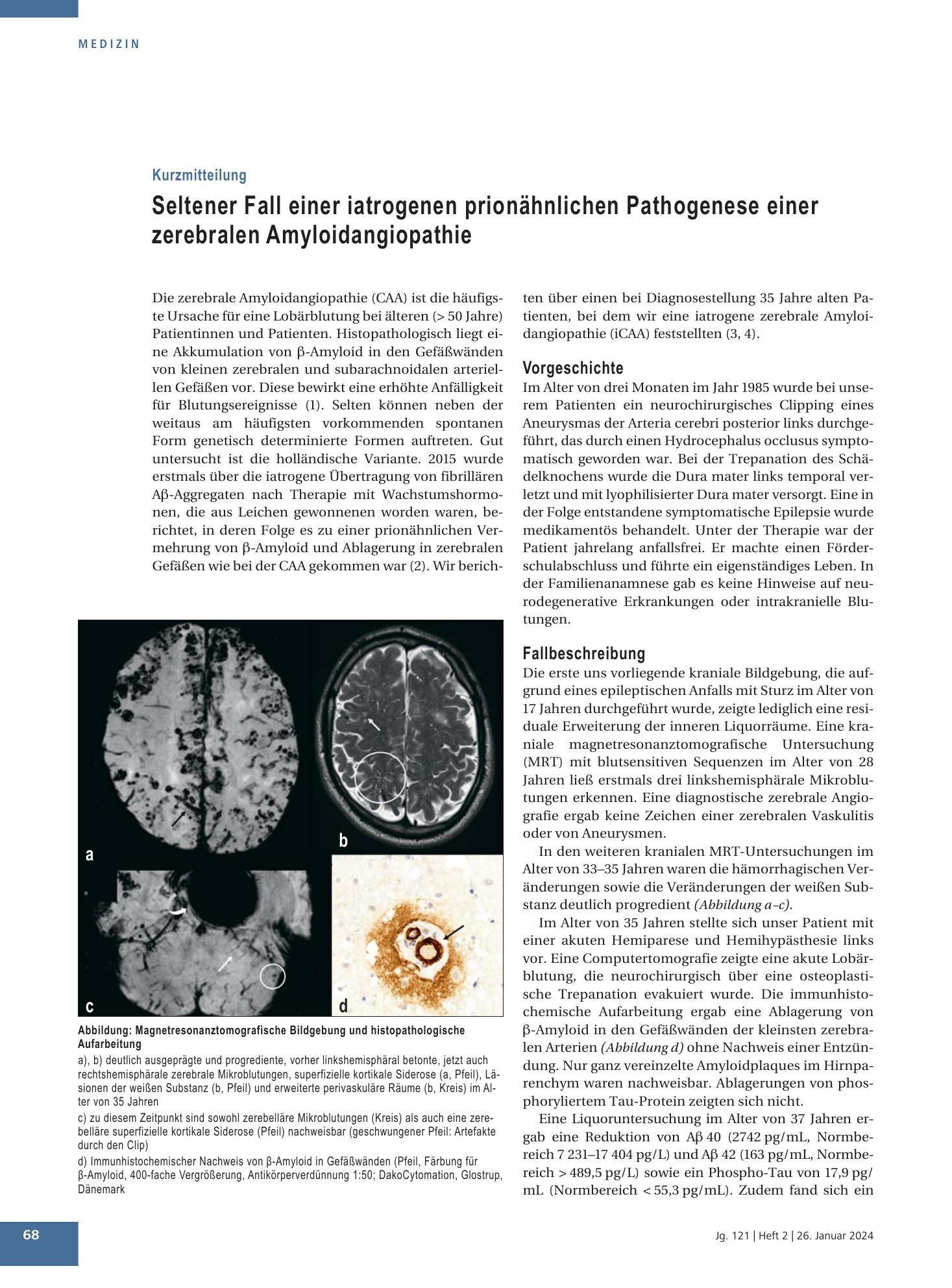Vorschauseite 1: Seltener Fall einer iatrogenen prionähnlichen Pathogenese einer zerebralen Amyloidangiopathie – Deutsches Ärzteblatt