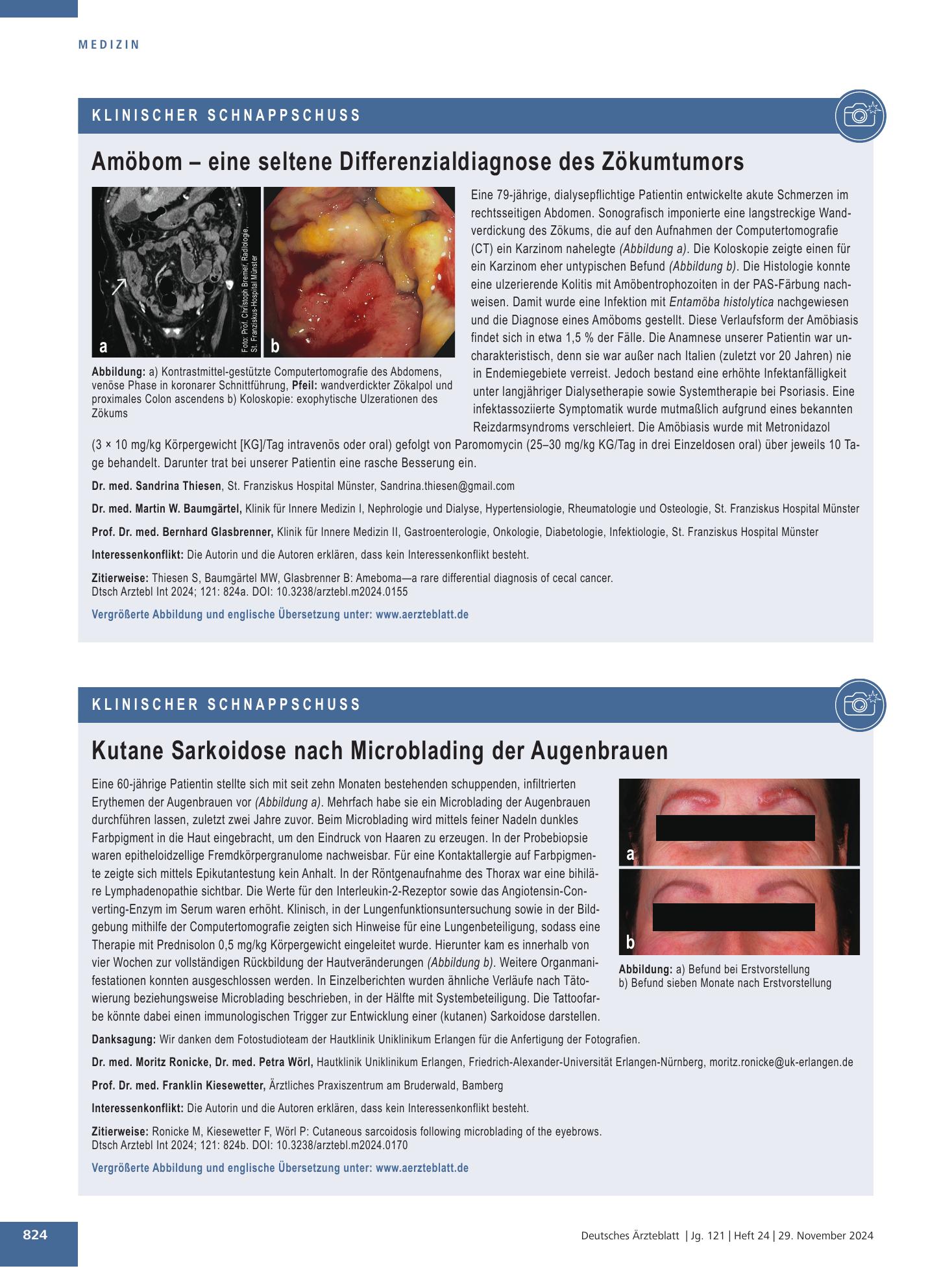 Vorschauseite 1: Kutane Sarkoidose nach Microblading der Augenbrauen – Deutsches Ärzteblatt