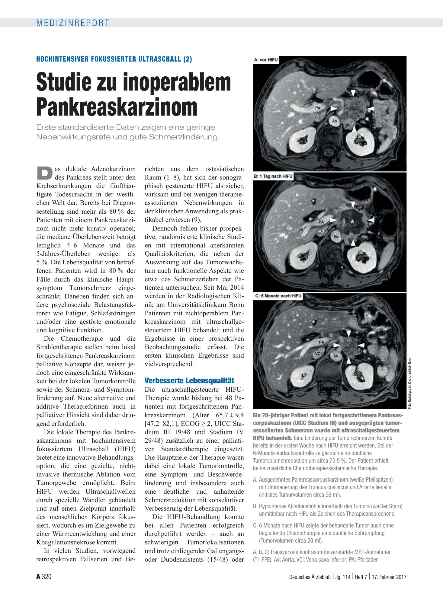 Vorschauseite 1: Hochintensiver fokussierter Ultraschall (2): Studie zu inoperablem Pankreaskarzinom – Deutsches Ärzteblatt