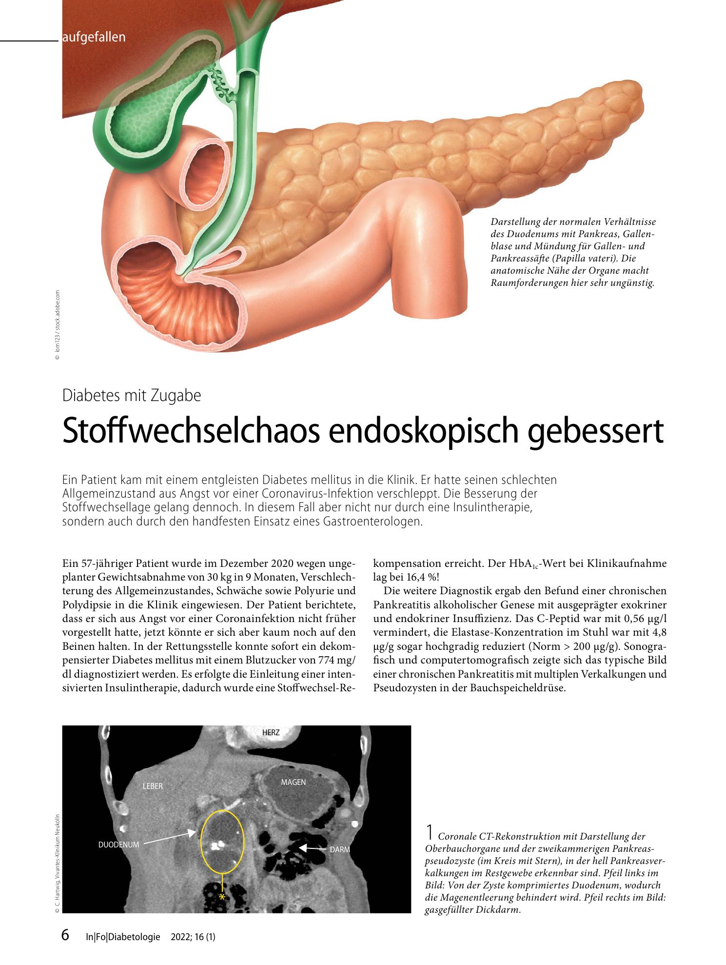 Vorschauseite 1: Stoffwechselchaos endoskopisch gebessert