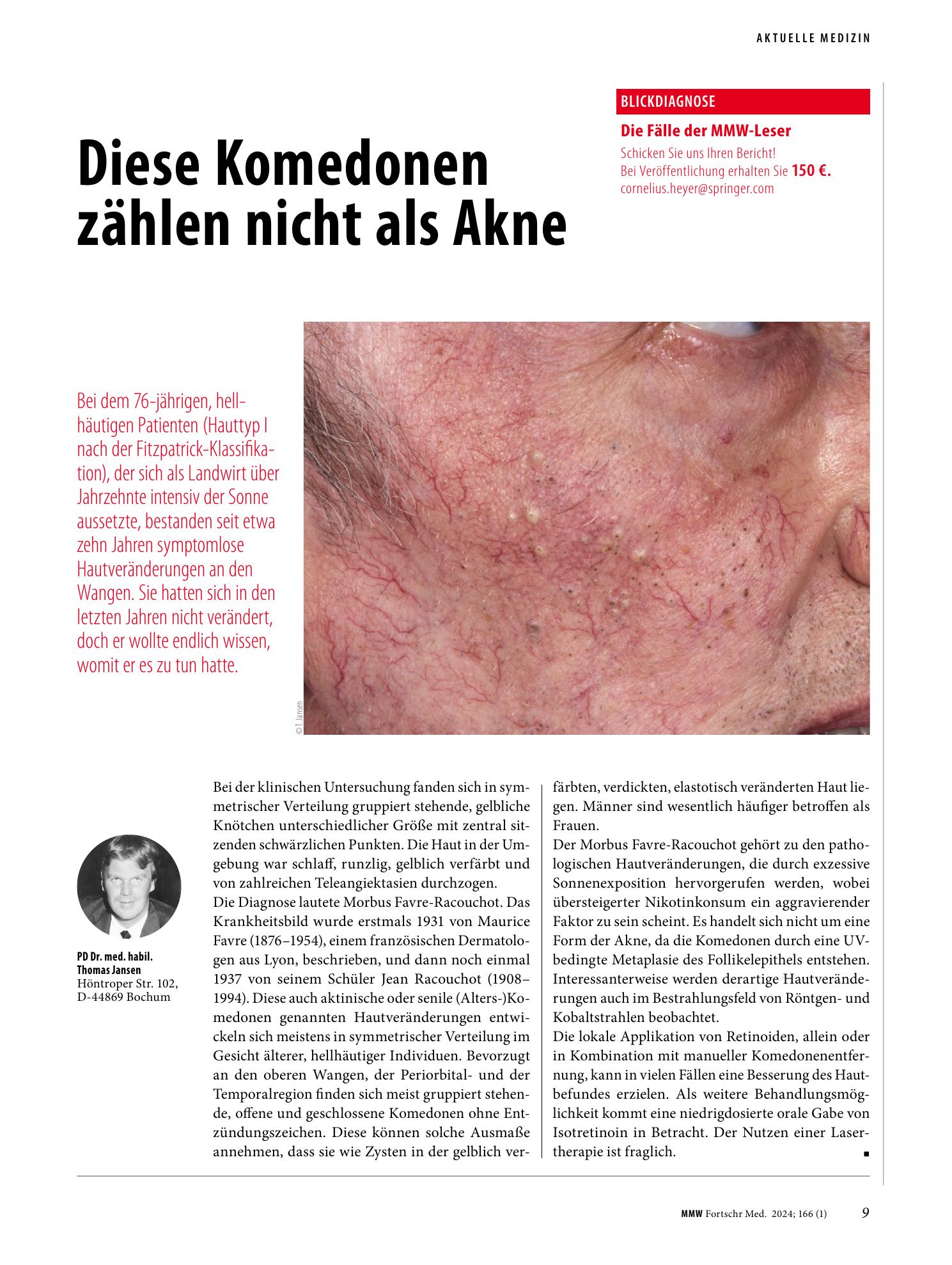 Vorschauseite 1: Diese Komedonen zählen nicht als Akne