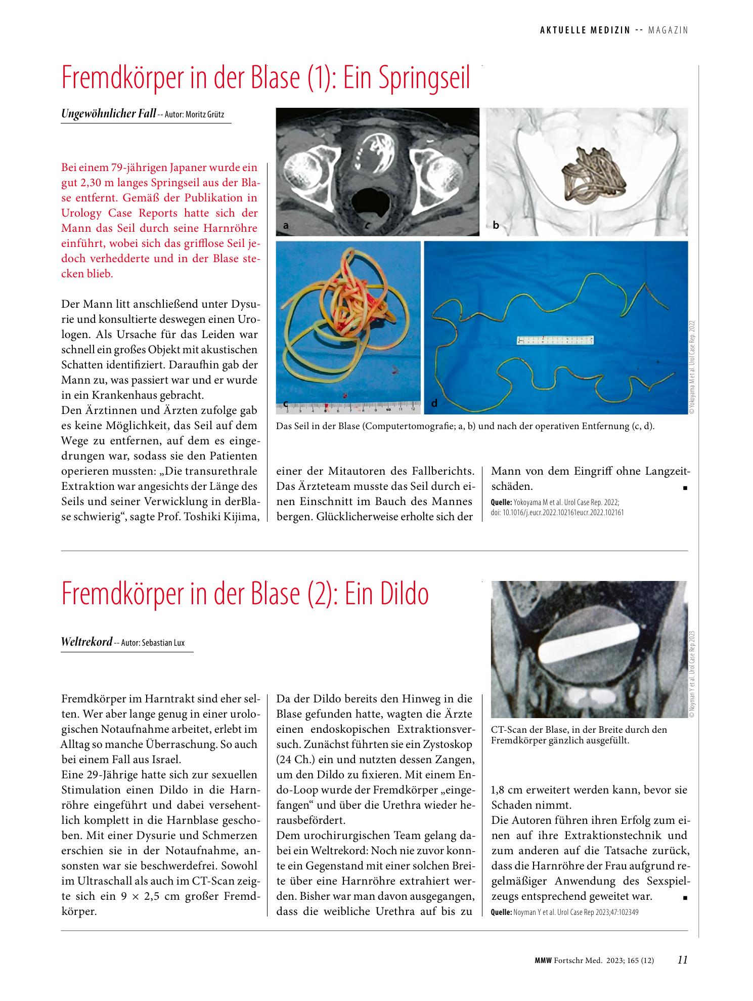 Vorschauseite 1: Fremdkörper in der Blase (1): Ein Springseil