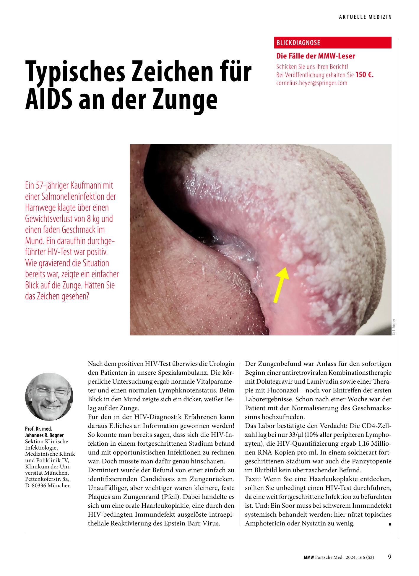 Vorschauseite 1: Typisches Zeichen für AIDS an der Zunge