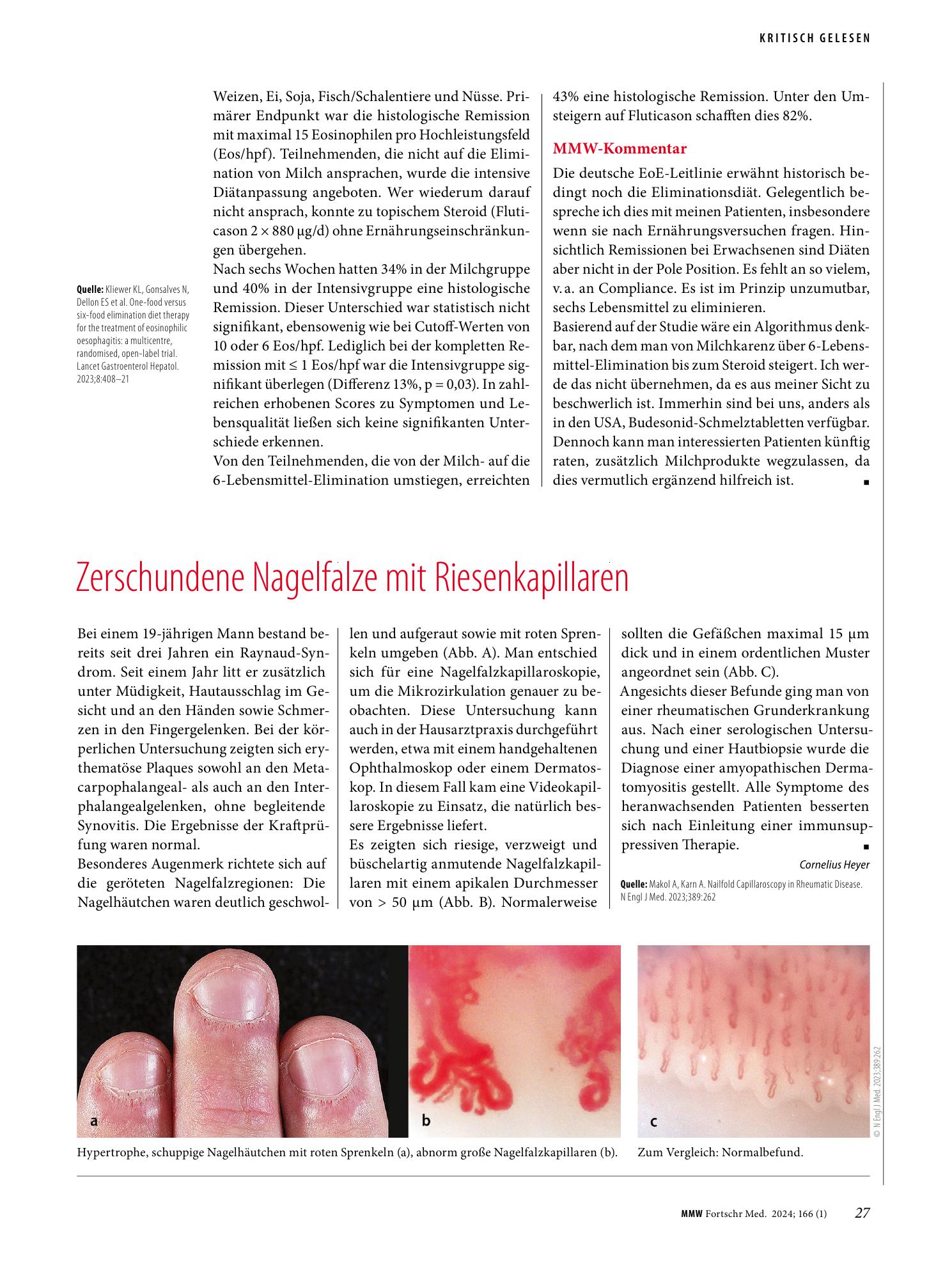 Vorschauseite 1: Zerschundene Nagelfalze mit Riesenkapillaren