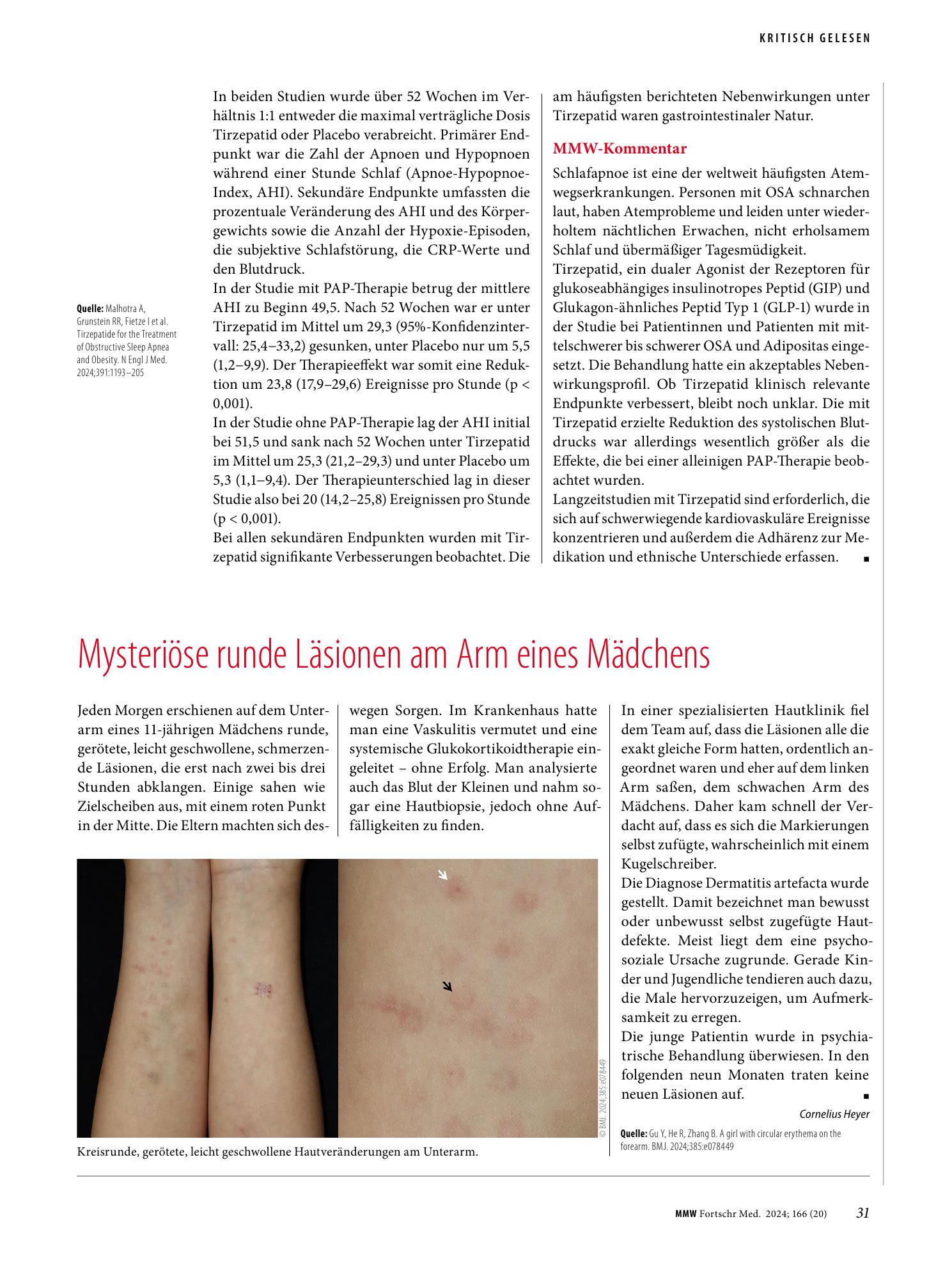 Vorschauseite 1: Mysteriöse runde Läsionen am Arm eines Mädchens