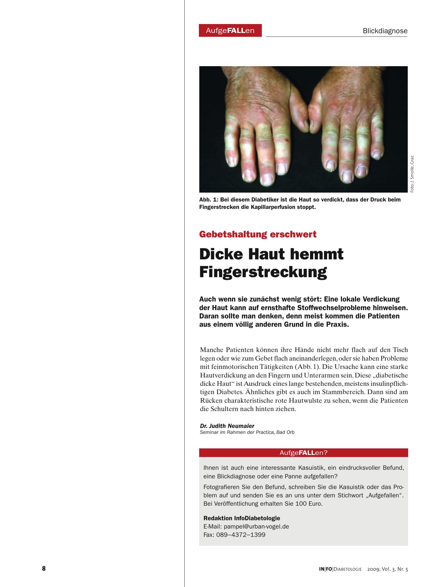 Vorschauseite 1: Dicke Haut hemmt Fingerstreckung