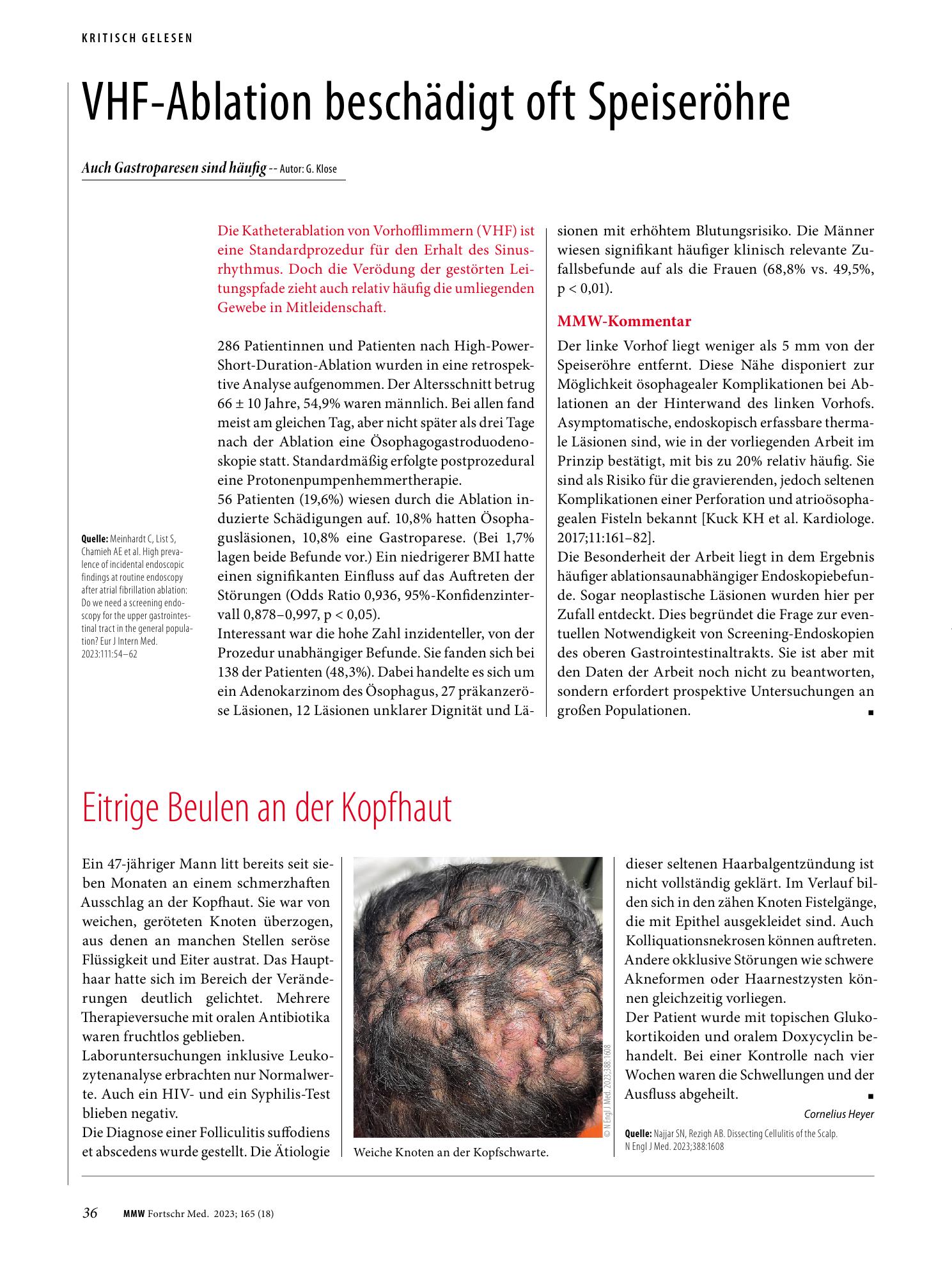 Vorschauseite 1: VHF-Ablation beschädigt oft Speiseröhre