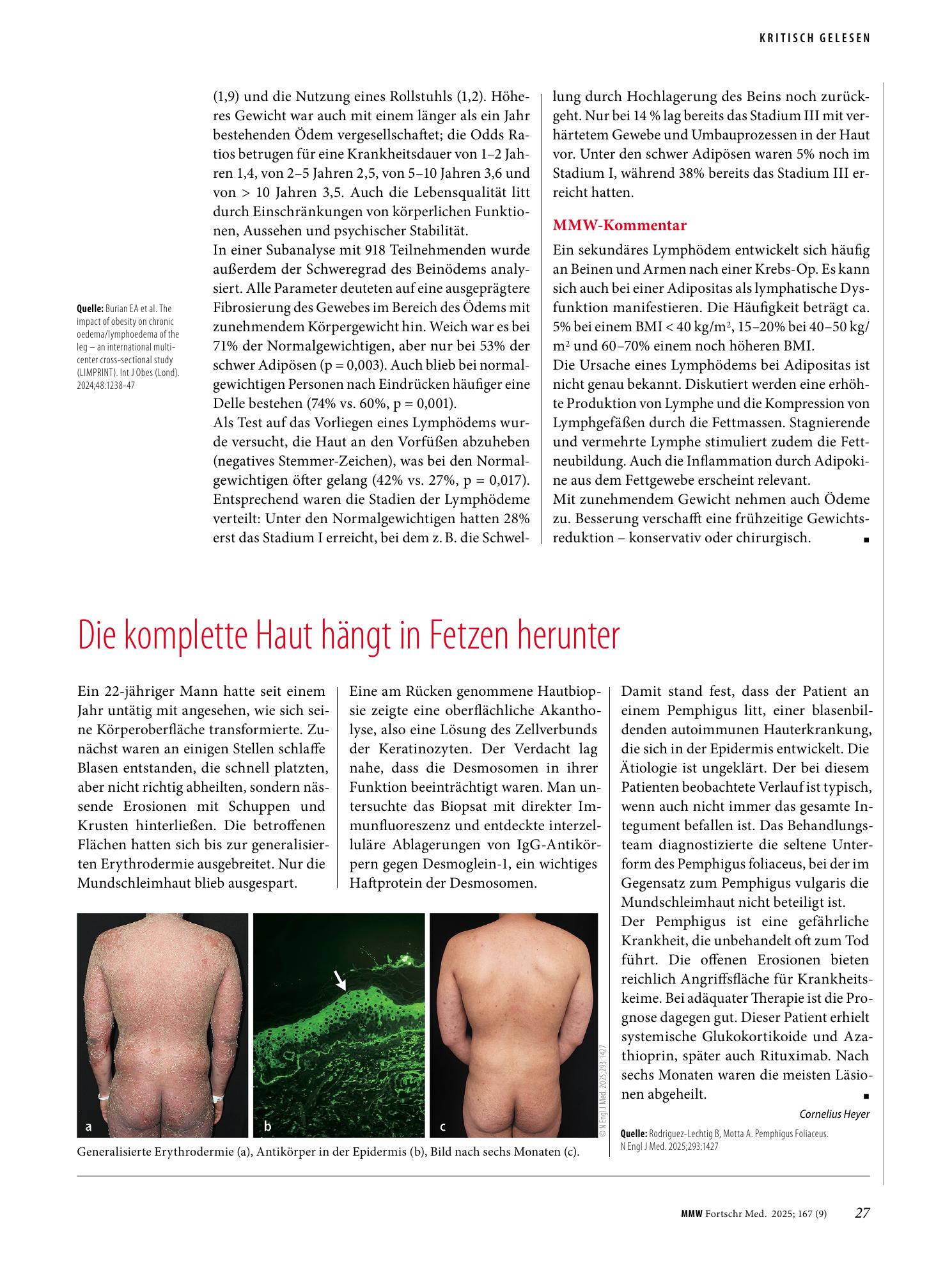 Vorschauseite 1: Die komplette Haut hängt in Fetzen herunter