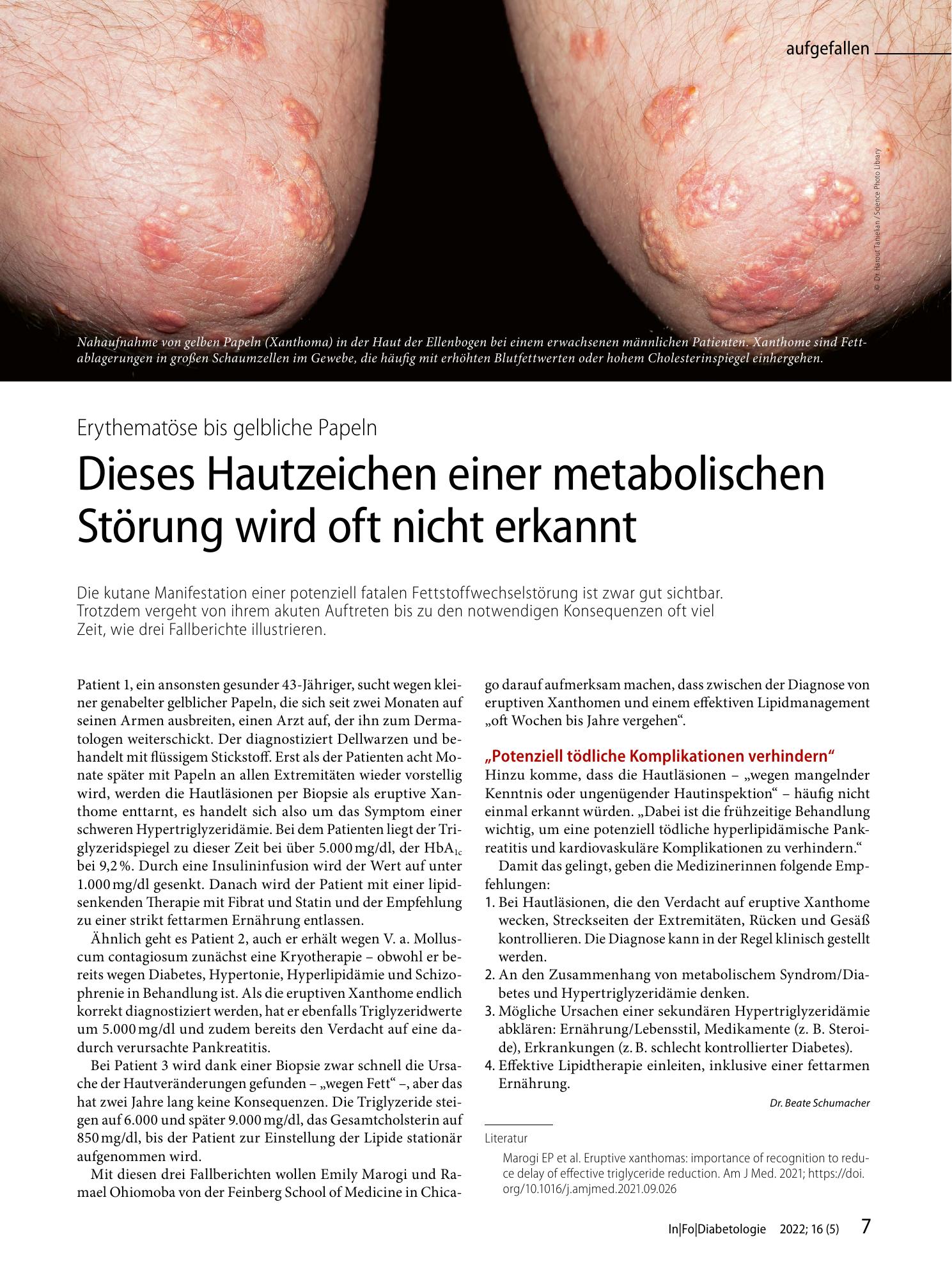 Vorschauseite 1: Dieses Hautzeichen einer metabolischen Störung wird oft nicht erkannt