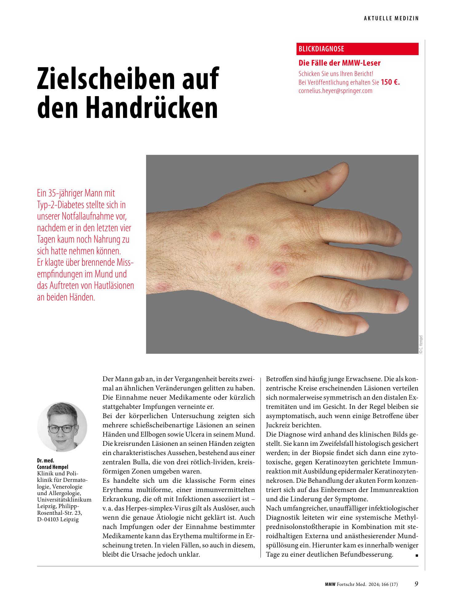 Vorschauseite 1: Zielscheiben auf den Handrücken