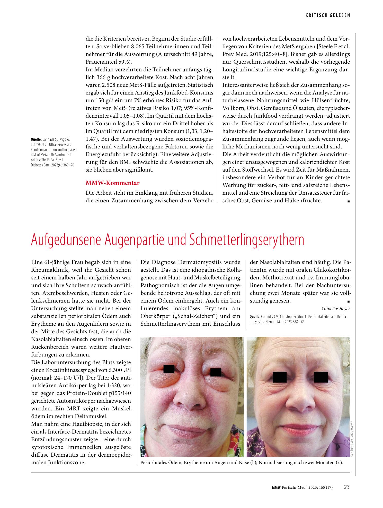 Vorschauseite 1: Aufgedunsene Augenpartie und Schmetterlingserythem