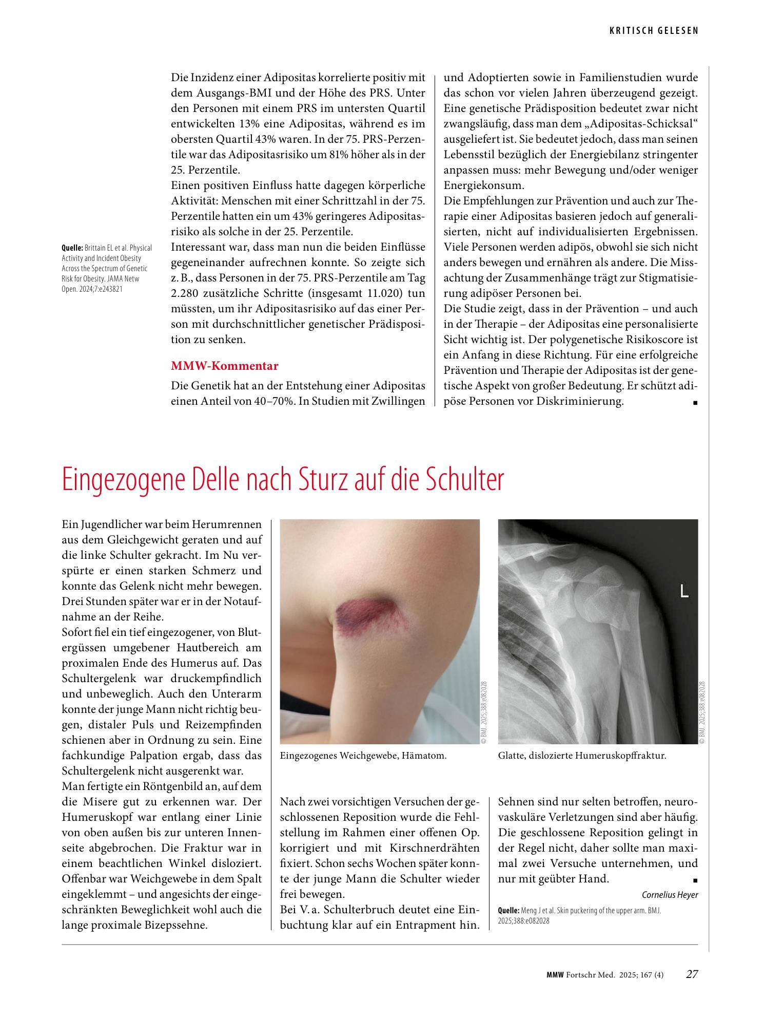 Vorschauseite 1: Eingezogene Delle nach Sturz auf die Schulter