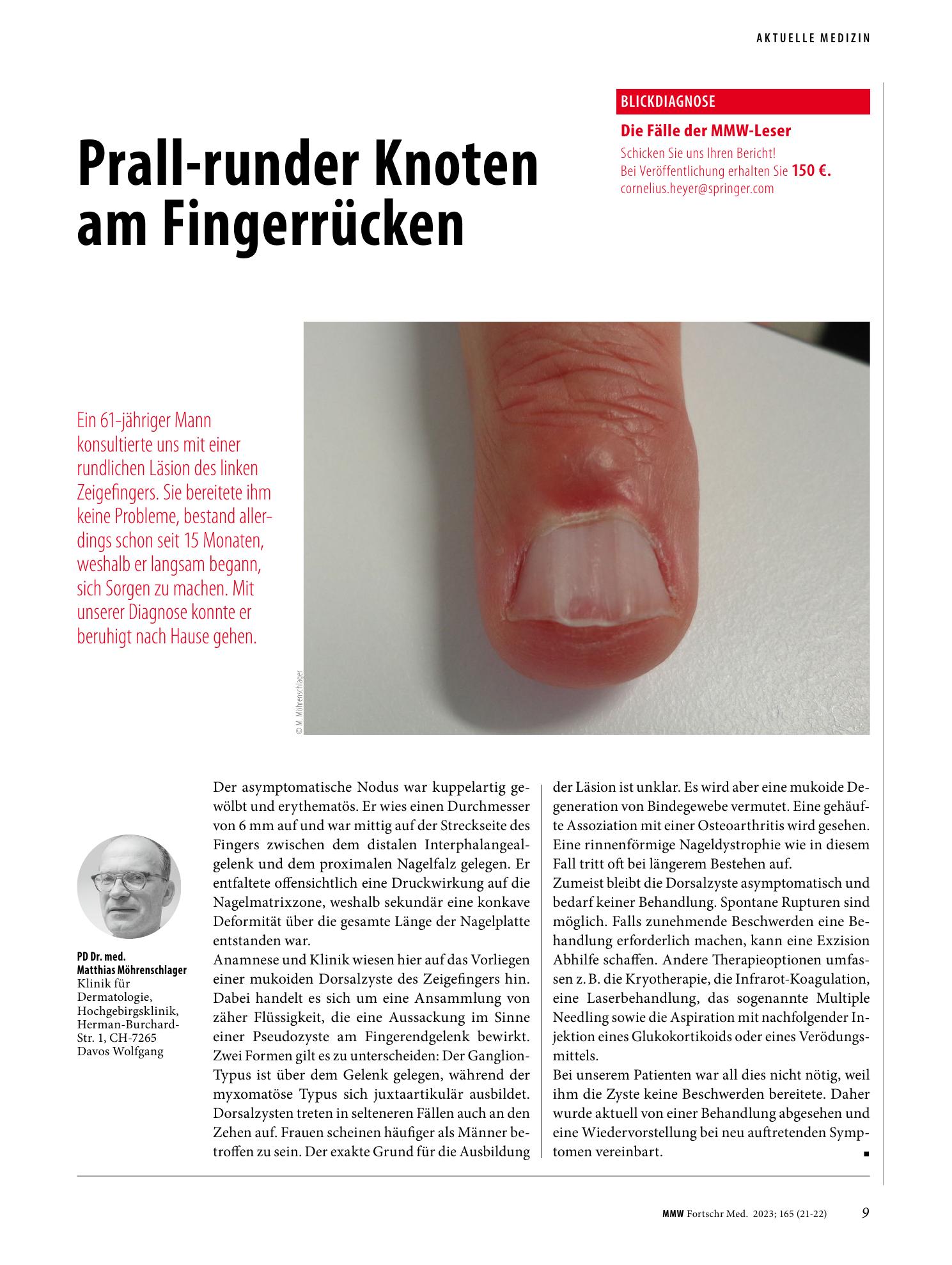 Vorschauseite 1: Prall-runder Knoten am Fingerrücken