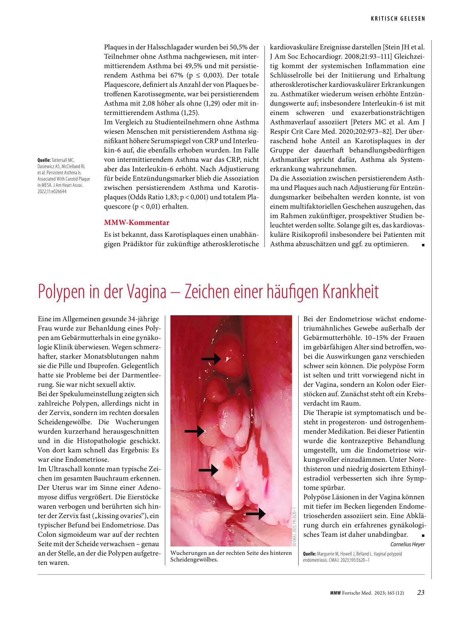 Vorschauseite 1: Polypen in der Vagina - Zeichen einer häufigen Krankheit