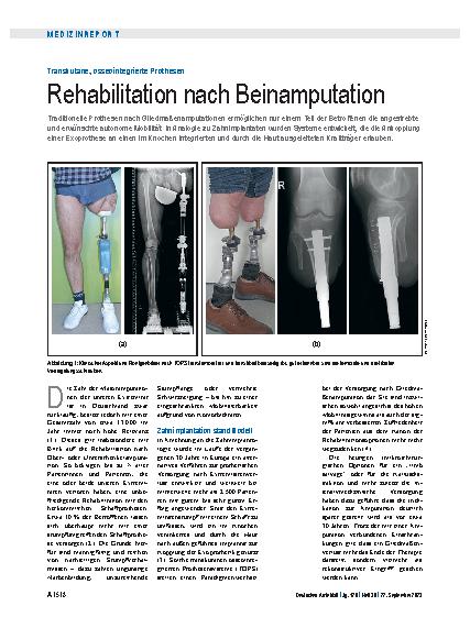 Vorschauseite 1: Transkutane, osseointegrierte Prothesen: Rehabilitation nach Beinamputation