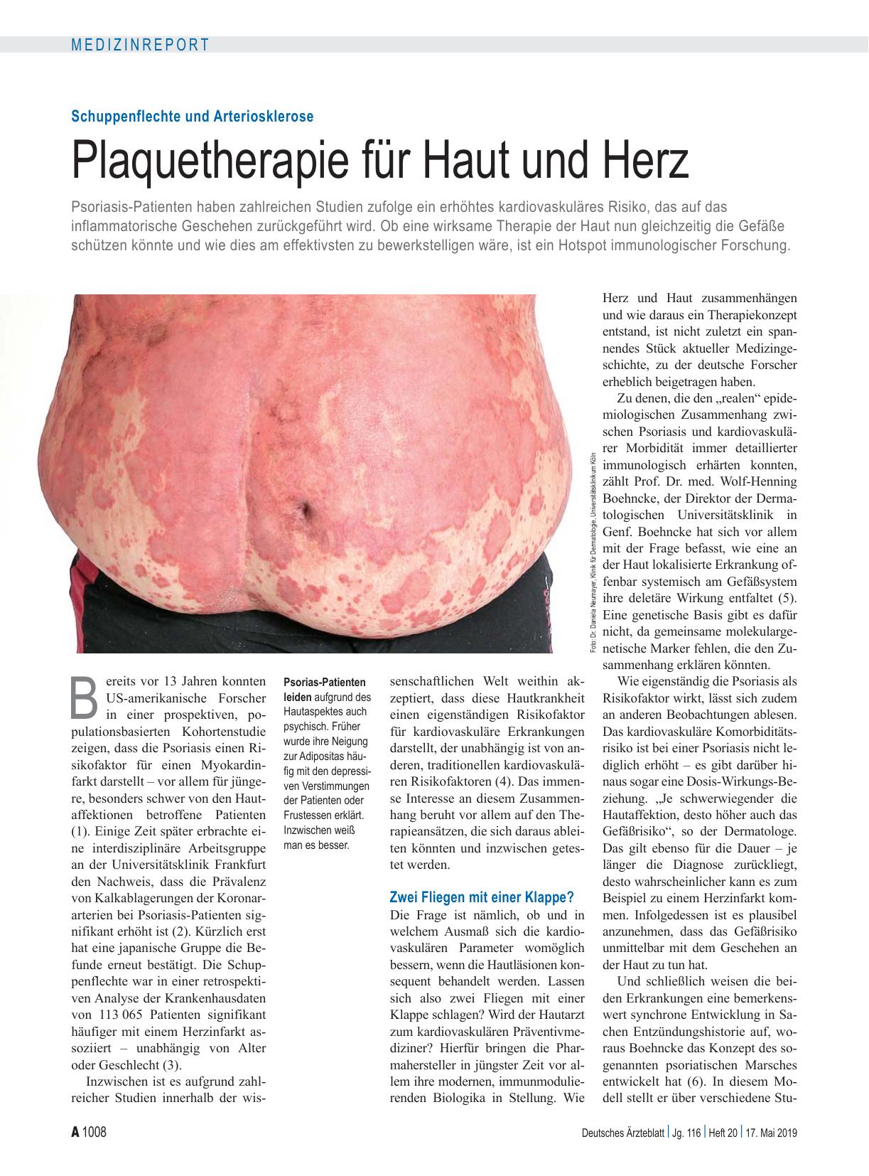 Vorschauseite 1: Schuppenflechte und Arteriosklerose: Plaquetherapie für Haut und Herz