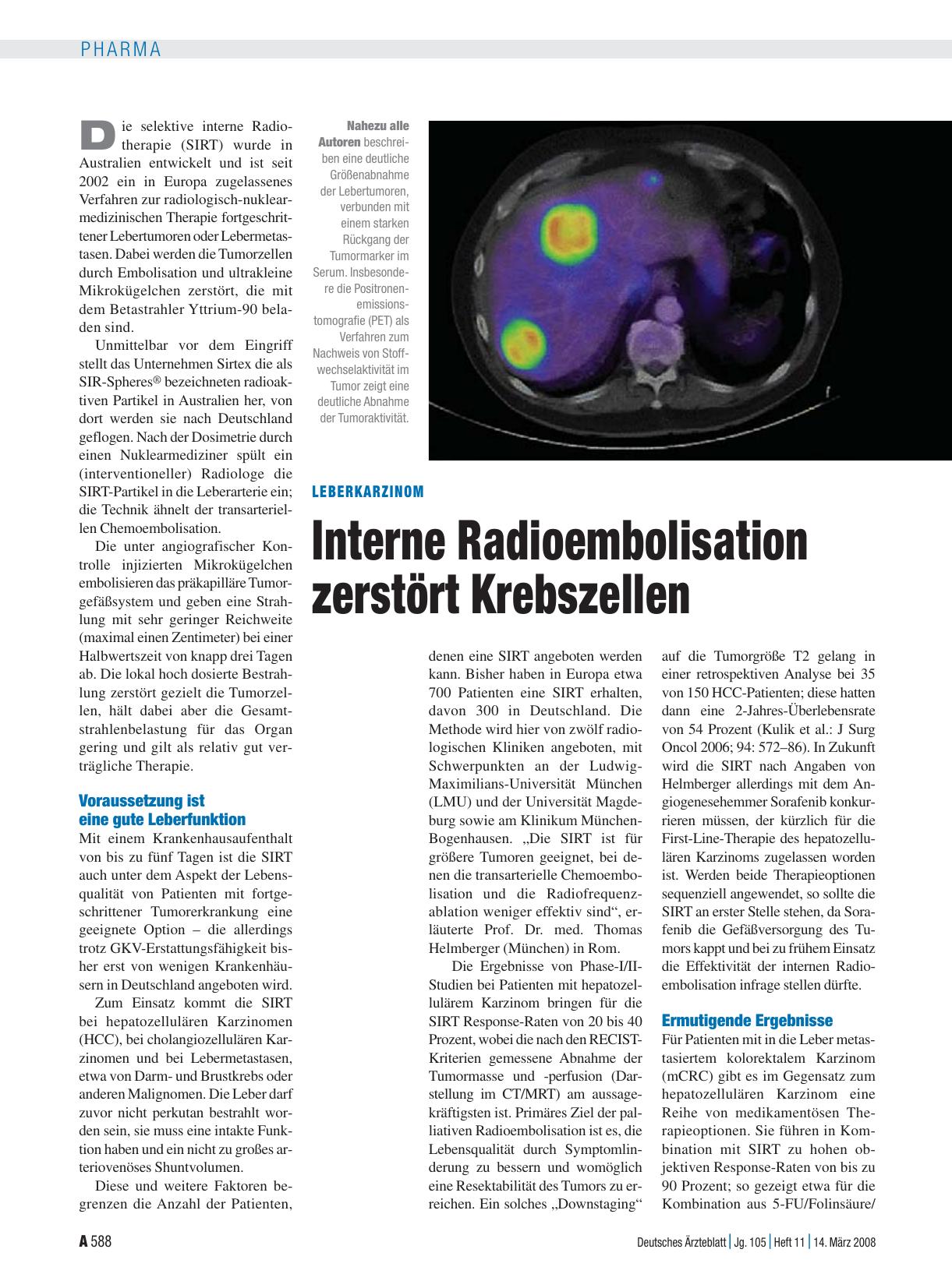 Vorschauseite 1: Leberkarzinom: Interne Radioembolisation zerstört Krebszellen