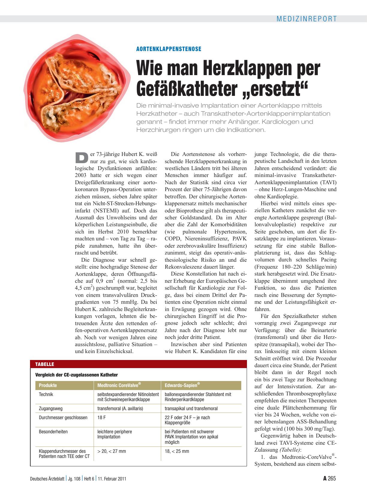 Vorschauseite 1: Aortenklappenstenose: Wie man Herzklappen per Gefäßkatheter „ersetzt“