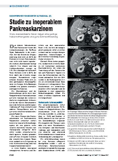 Vorschauseite 1: Hochintensiver fokussierter Ultraschall (2): Studie zu inoperablem Pankreaskarzinom