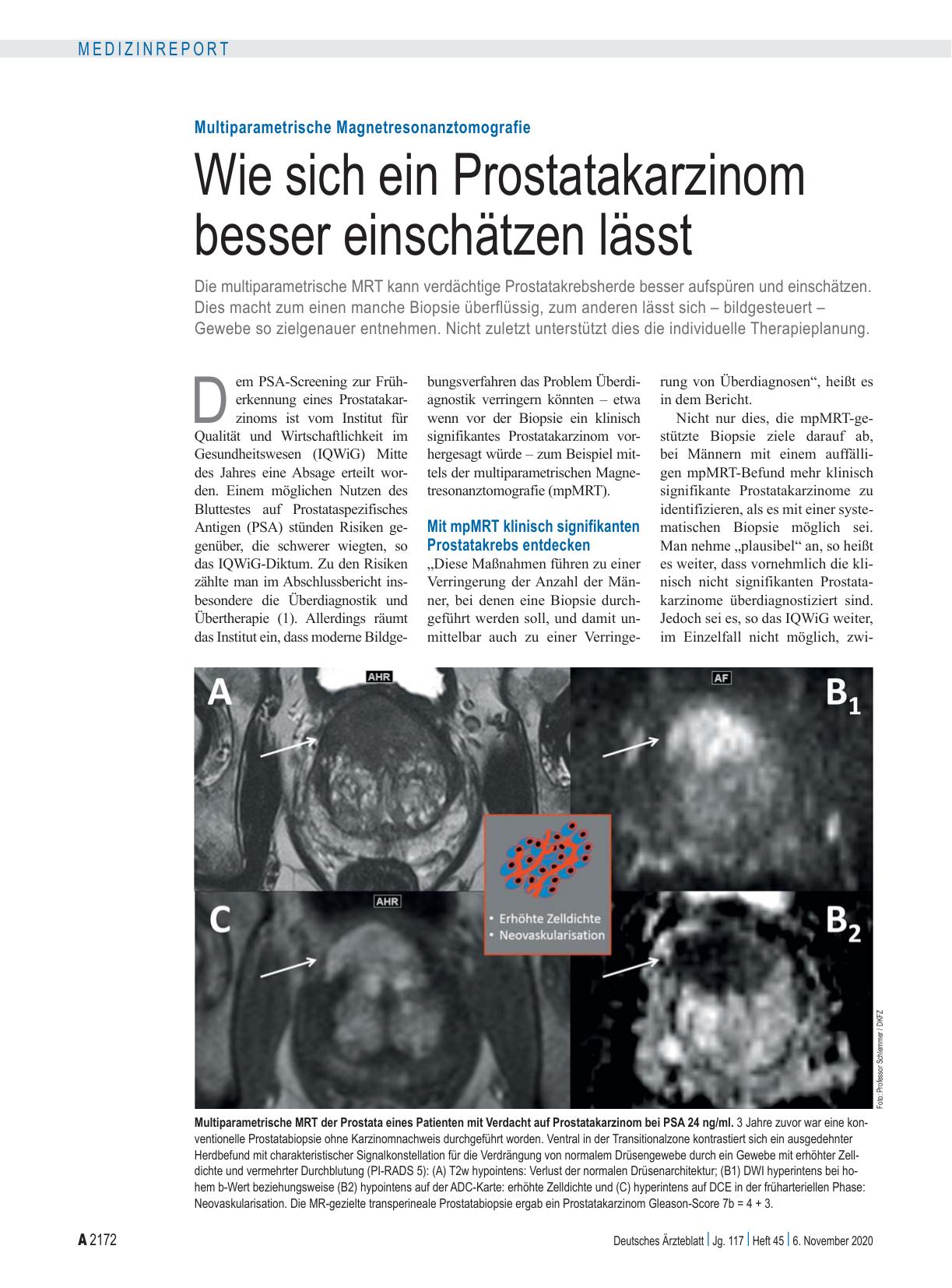 Vorschauseite 1: Multiparametrische Magnetresonanztomografie: Wie sich ein Prostatakarzinom besser einschätzen lässt