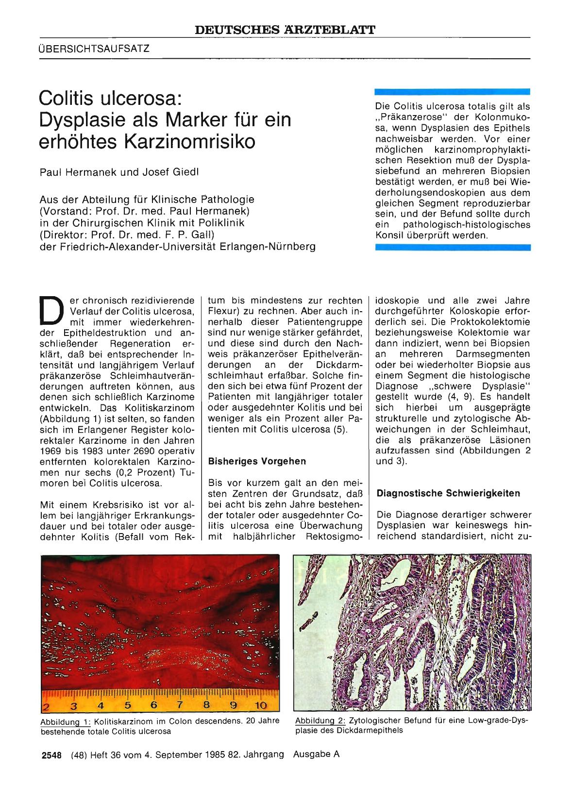 Vorschauseite 1: Colitis ulcerosa: Dysplasie als Marker für ein erhöhtes Karzinomrisiko
