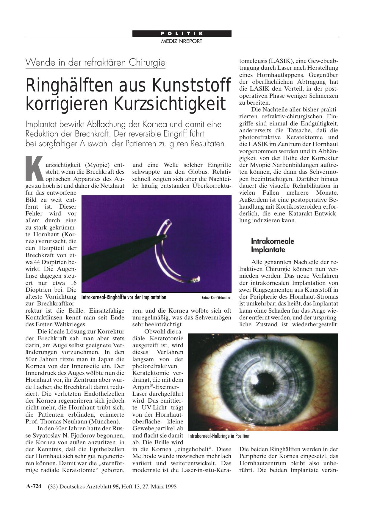 Vorschauseite 1: Wende in der refraktären Chirurgie: Ringhälften aus Kunststoff korrigieren Kurzsichtigkeit