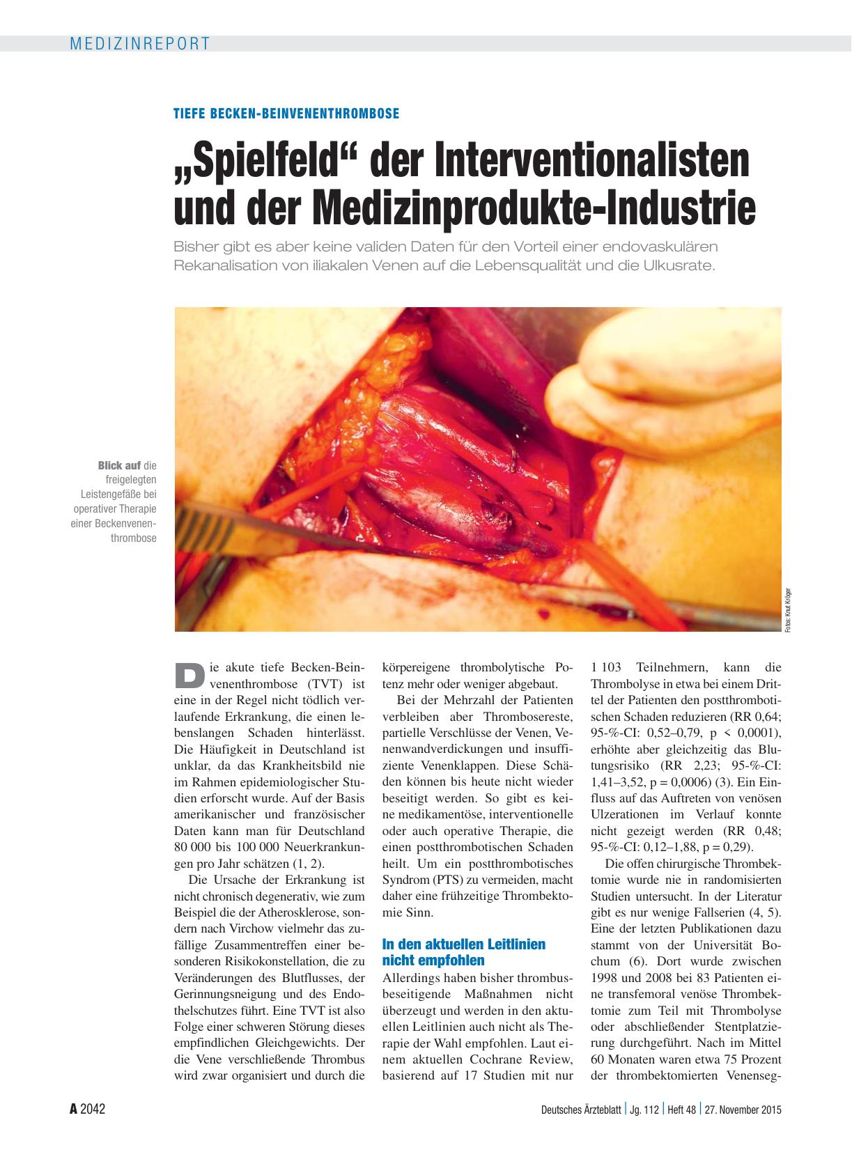 Vorschauseite 1: Tiefe Becken-Beinvenenthrombose: „Spielfeld“ der Interventionalisten und der Medizinprodukte-Industrie