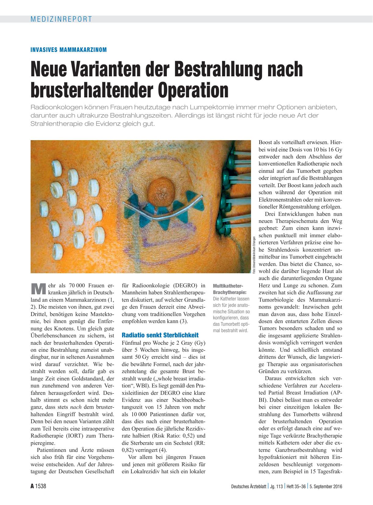 Vorschauseite 1: Invasives Mammakarzinom: Neue Varianten der Bestrahlung nach brusterhaltender Operation