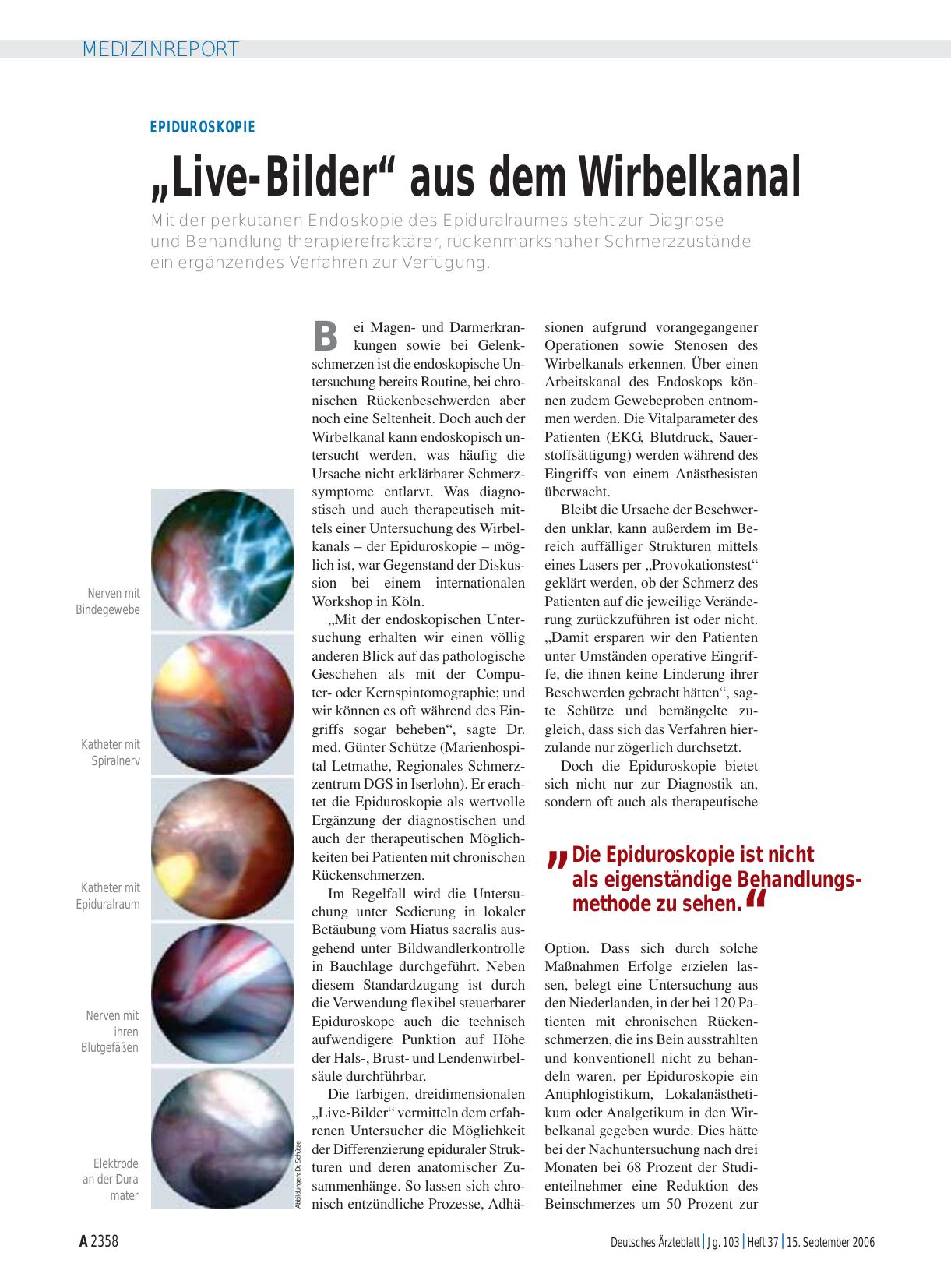 Vorschauseite 1: Epiduroskopie: „Live-Bilder“ aus dem Wirbelkanal