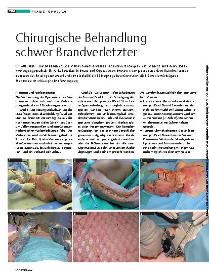 Vorschauseite 1: Chirurgische Behandlung schwer Brandverletzter