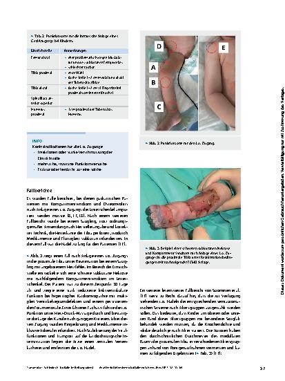 Vorschauseite 3: Notfälle im Rettungsdienst und in der Klinik: Gefäßzugänge bei Kindern