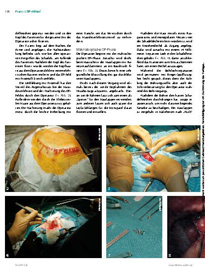Vorschauseite 4: Das Hirnaneurysma