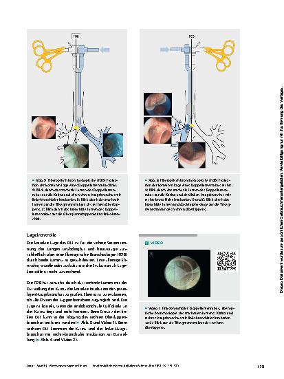 Vorschauseite 6: Atemwegsmanagement in der Thoraxanästhesie mit dem Doppellumentubus