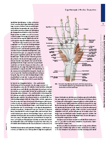 Vorschauseite 2: Ergotherapie bei Morbus Dupuytren – Auf die Streckung kommt es an