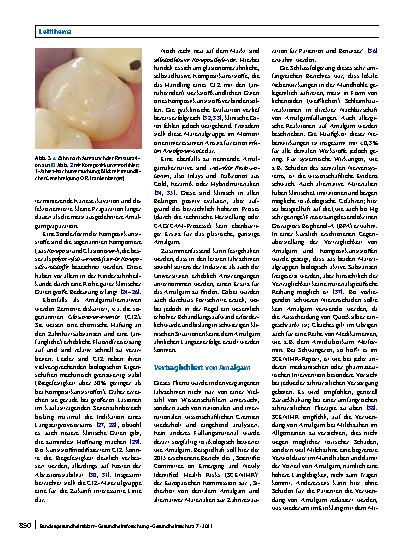 Vorschauseite 4: Amalgam und Alternativen – Diskussionen zur Quecksilberreduktion in der Umwelt