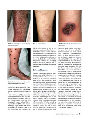 Vorschauseite 3: Wunden durch Vaskulitiden – aktuelle Klassifikation, Diagnostik und Therapie
