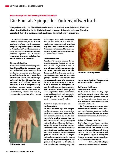 Vorschauseite 1: Die Haut als Spiegel des Zuckerstoffwechsels