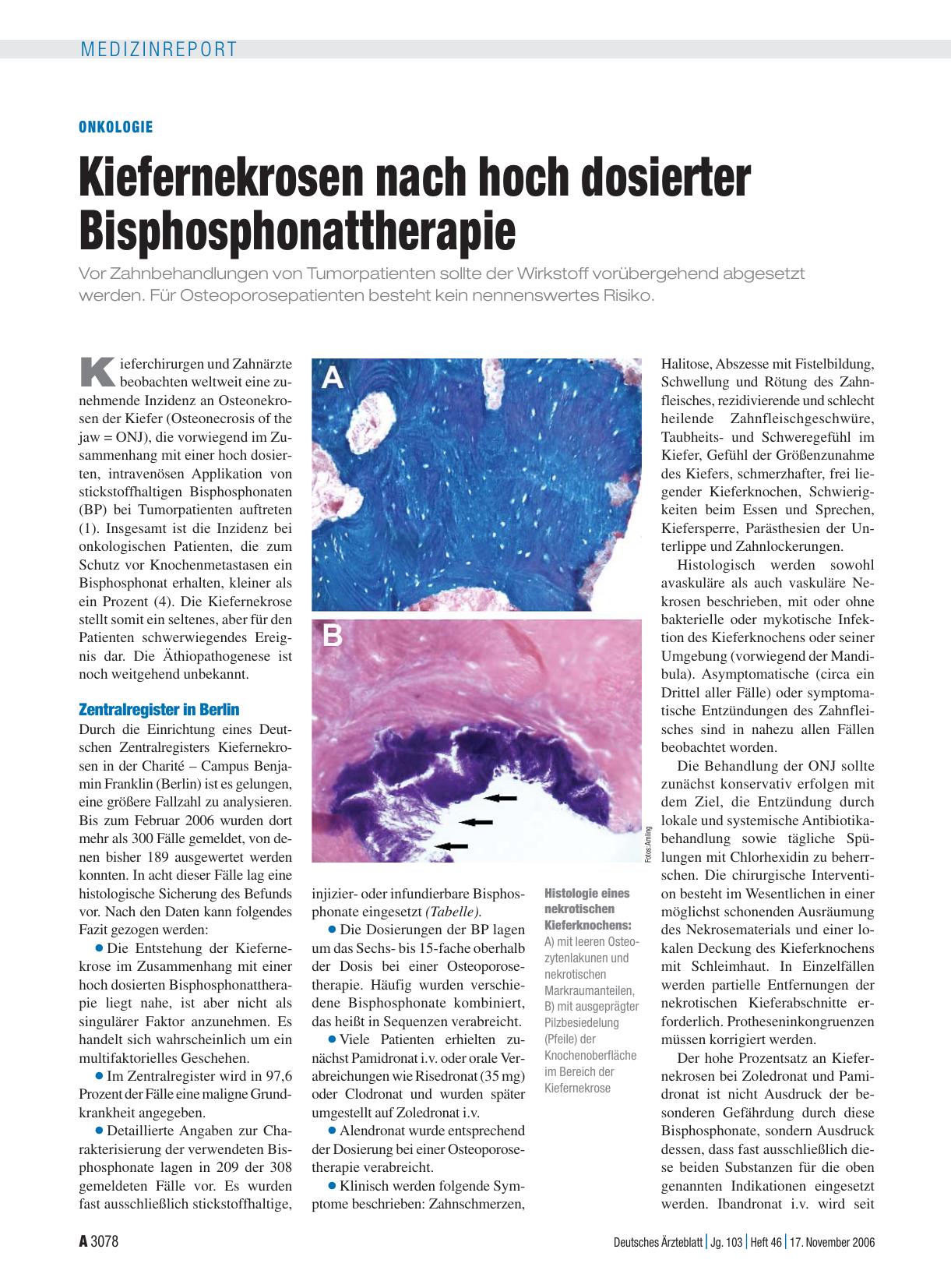 Vorschauseite 1: Onkologie: Kiefernekrosen nach hoch dosierter Bisphosphonattherapie