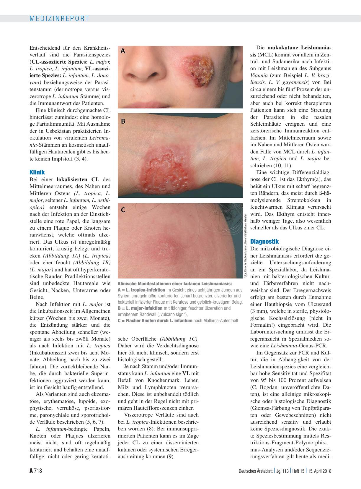Vorschauseite 2: Importierte Dermatose: Kutane Leishmaniasis