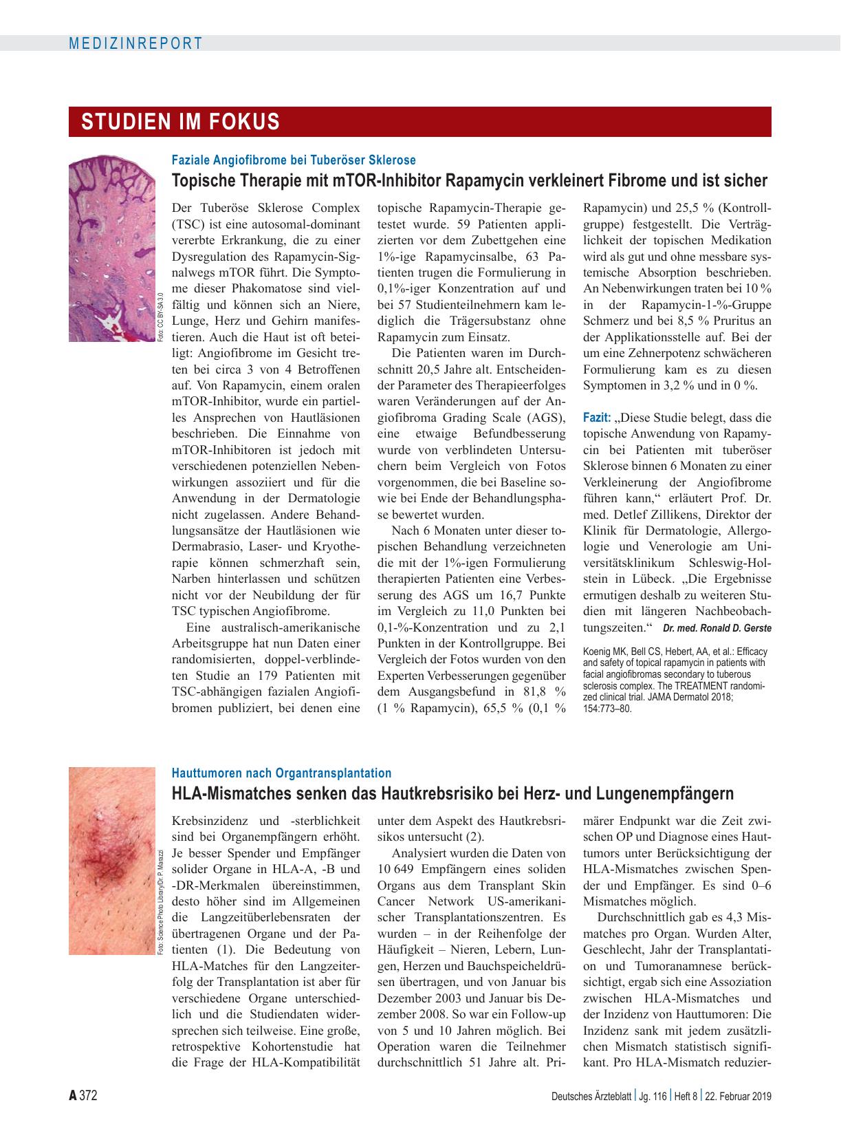 Vorschauseite 1: Faziale Angiofibrome bei Tuberöser Sklerose: Topische Therapie mit mTOR-Inhibitor Rapamycin verkleinert Fibrome und ist sicher