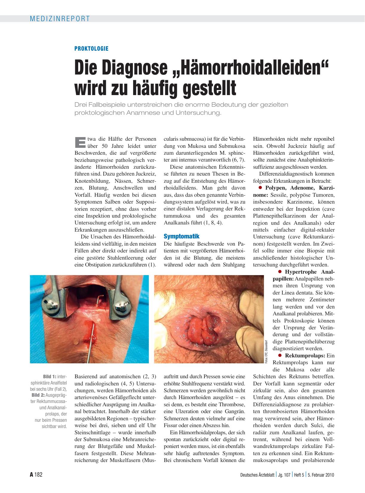 Vorschauseite 1: Proktologie: Die Diagnose „Hämorrhoidalleiden“ wird zu häufig gestellt