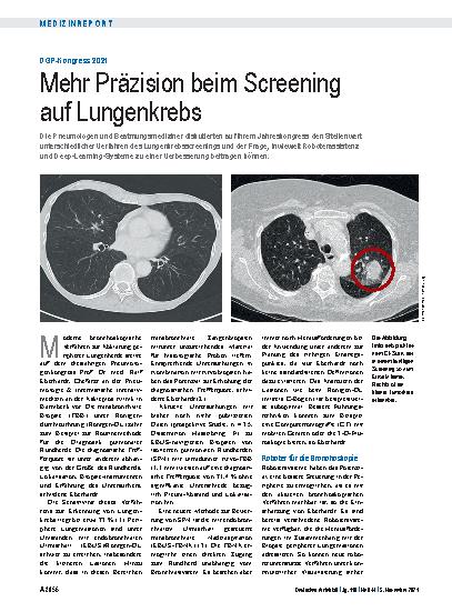 Vorschauseite 1: DGP-Kongress 2021: Mehr Präzision beim Screening auf Lungenkrebs